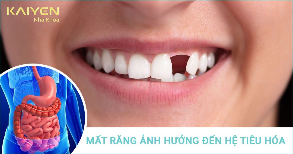 Mất răng gây ra nhiều hậu quả đối với hệ tiêu hóa