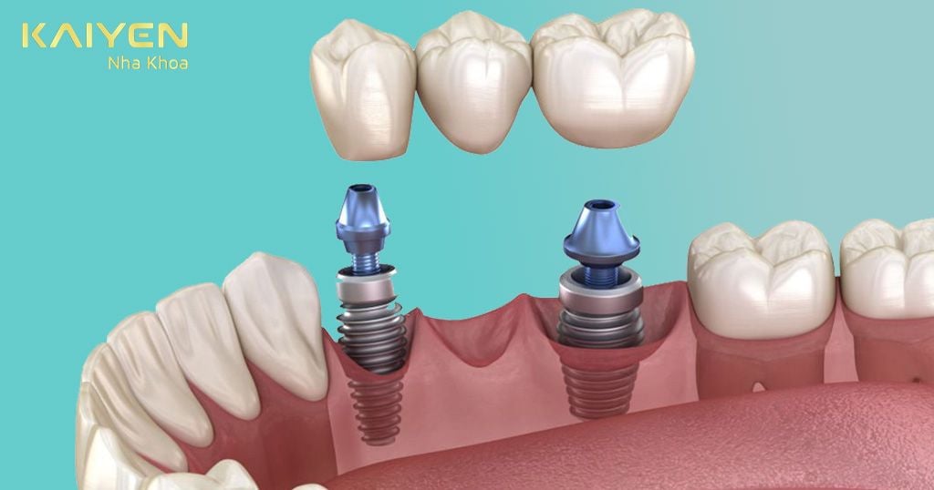 Cấy ghép Implant giúp cải thiện hệ tiêu hóa khỏe hơn