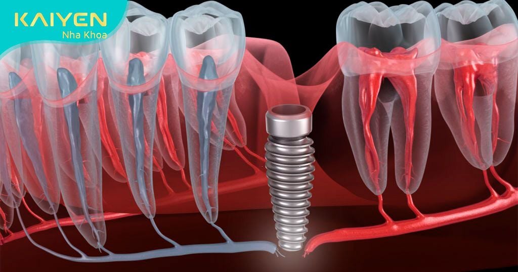 Đứt dây thần kinh dưới ổ răng do cấy ghép Implant không đúng quy trình