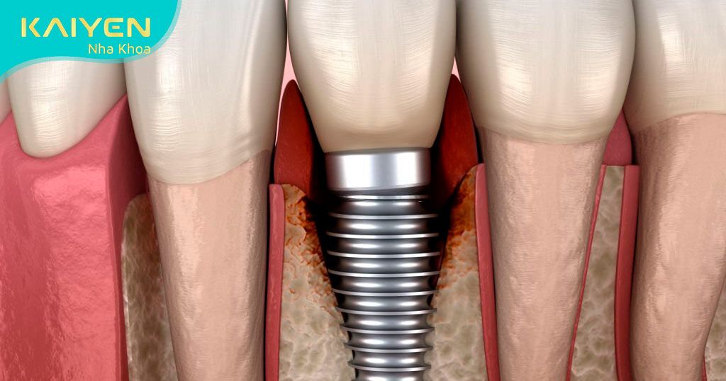 Vị trí cấy ghép Implant bị nhiễm trùng