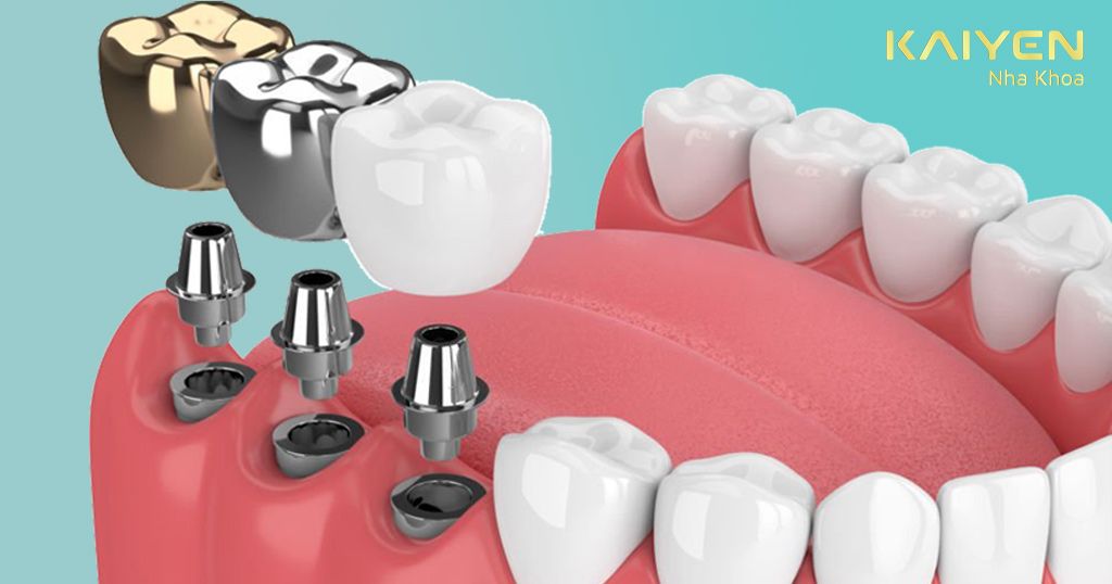 Cấy ghép răng Implant