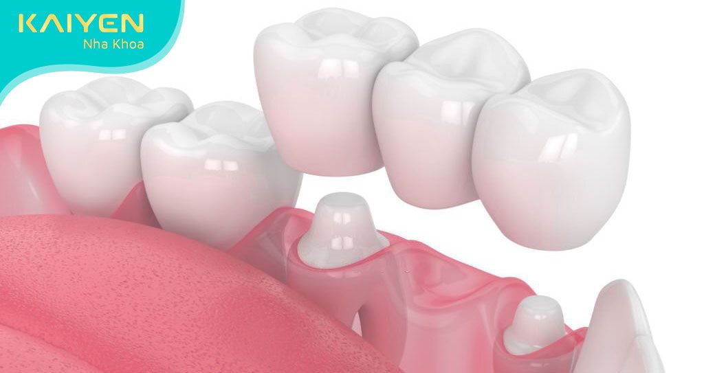 Bật mí cách chăm sóc cầu răng sứ giúp răng bền đẹp lâu dài