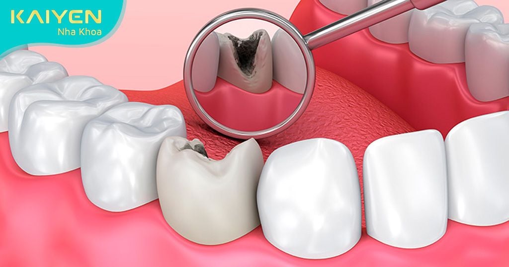 Chỉ đến nha khoa khi răng đau là một sai lầm dễ mắc phải khi chăm sóc răng