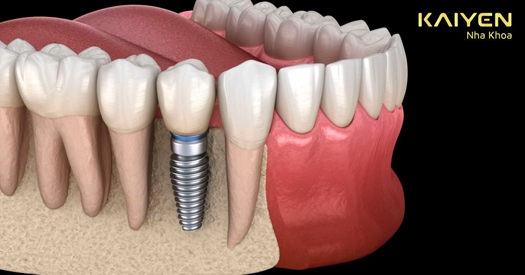 Chân răng Implant tạo lực kích thích xương hàm phát triển