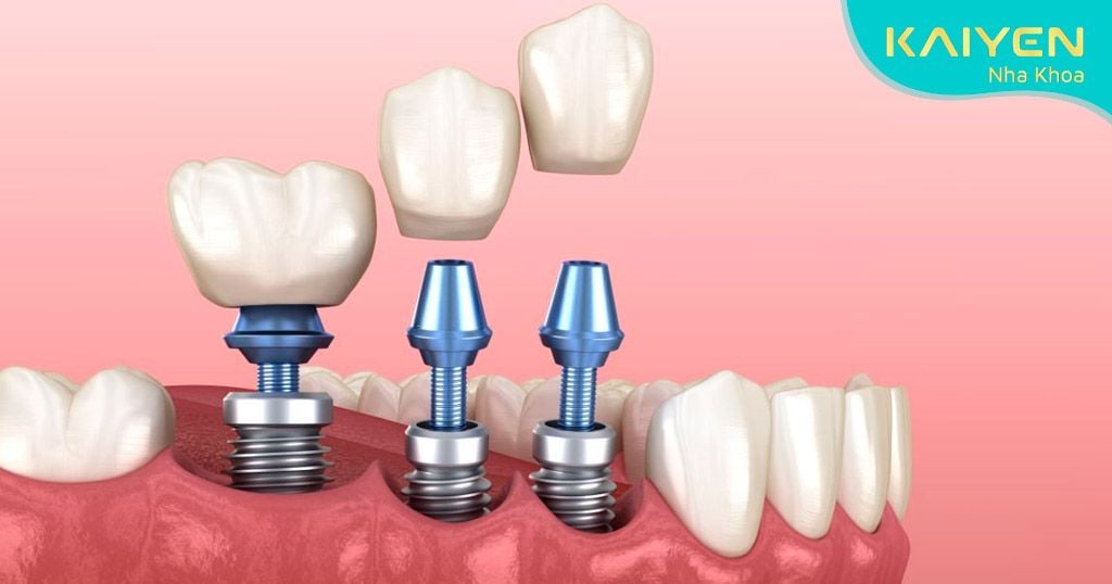 Giá trồng răng Implant bao gồm trụ răng, mão sứ, Abutment