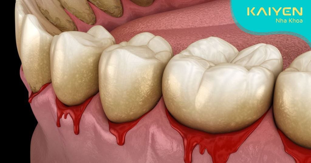 Bị chảy máu chân răng thiếu chất gì? Cần bổ sung những gì?