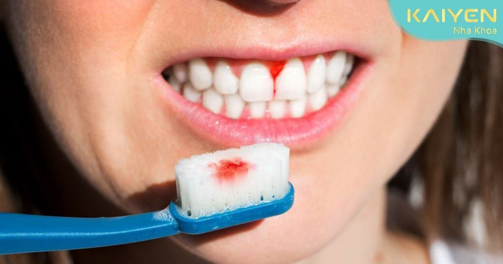 Chảy máu chân răng là triệu chứng phổ biến của các bệnh lý về răng miệng