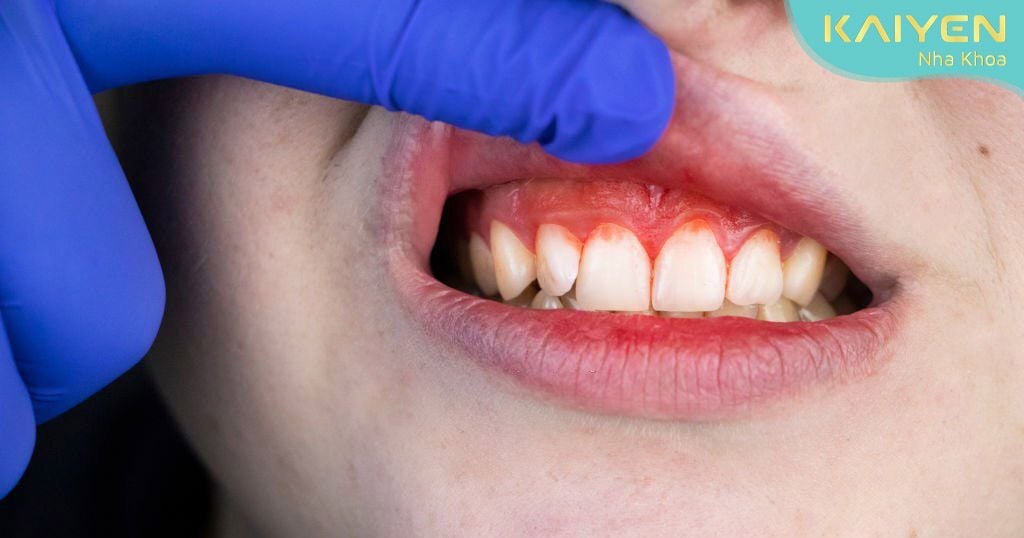 Chảy máu chân răng thường xuyên có thể là cảnh báo xấu của sức khỏe