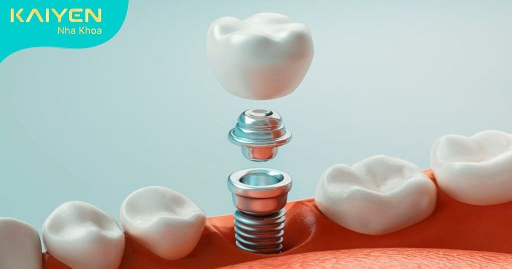Trồng răng Implant đòi hỏi kỹ thuật thực hiện phức tạp mức độ cao