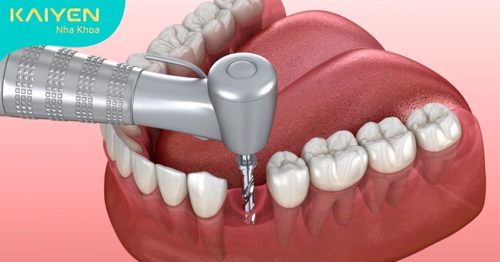 Tổn thương mạch máu trong quá trình cấy ghép Implant