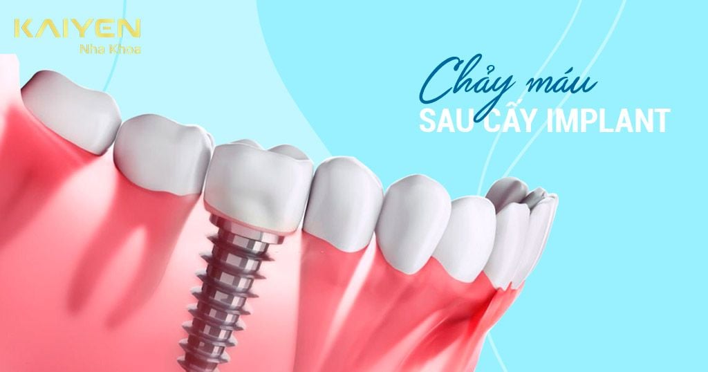 Chảy máu sau khi cắm Implant: Nguyên nhân và cách khắc phục