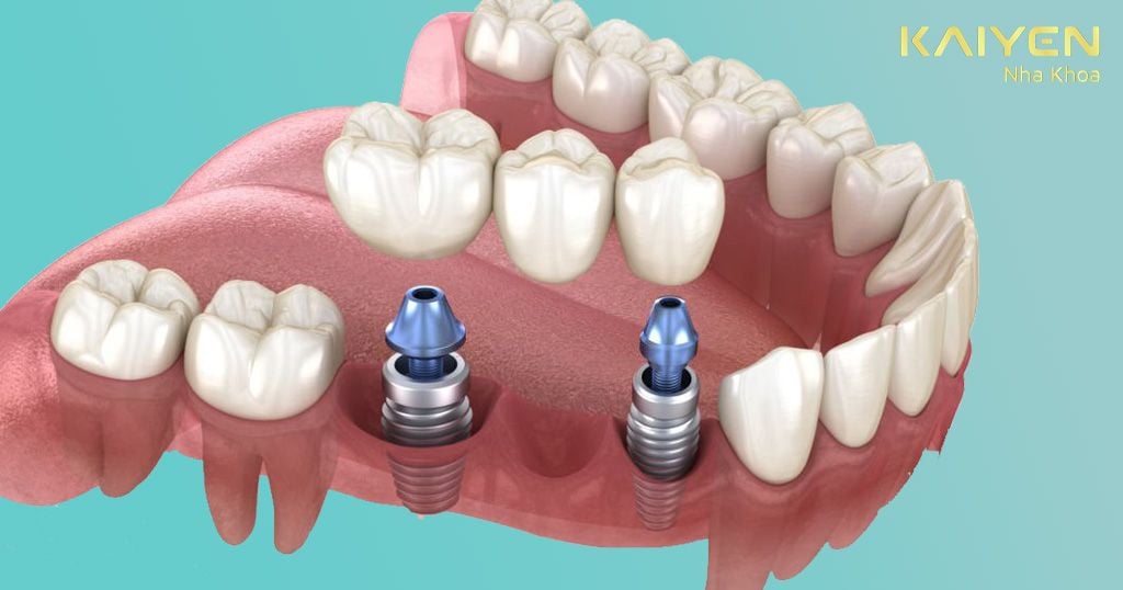 Trồng răng Implant