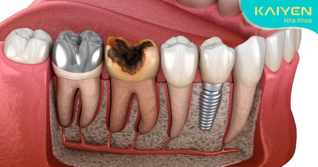 Người có bệnh lý răng miệng phải điều trị dứt điểm trước khi trồng Implant