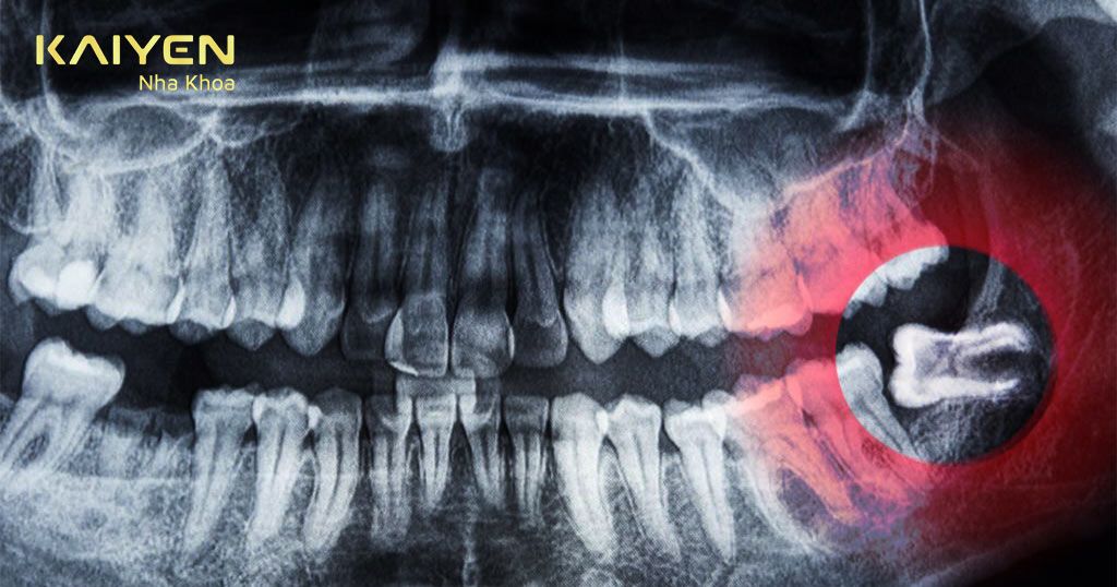 Chụp phim 3D ConeBeam hỗ trợ tốt cho các ca tiểu phẫu răng khôn