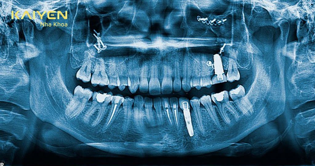 Hệ thống 3D ConeBeam giúp hỗ trợ đặt trụ Implant chuẩn xác