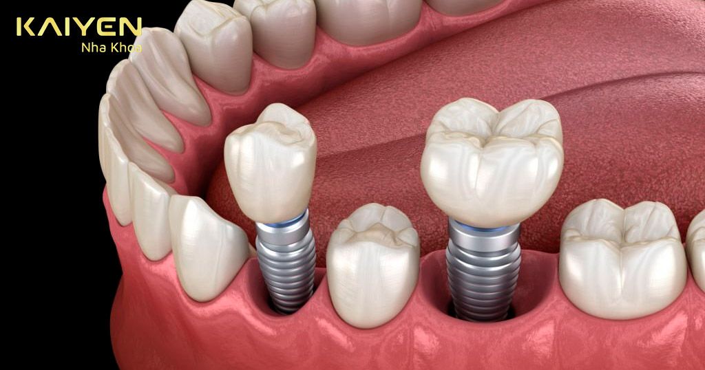 Trồng răng bằng implant đang được áp dụng rộng rãi trong nha khoa