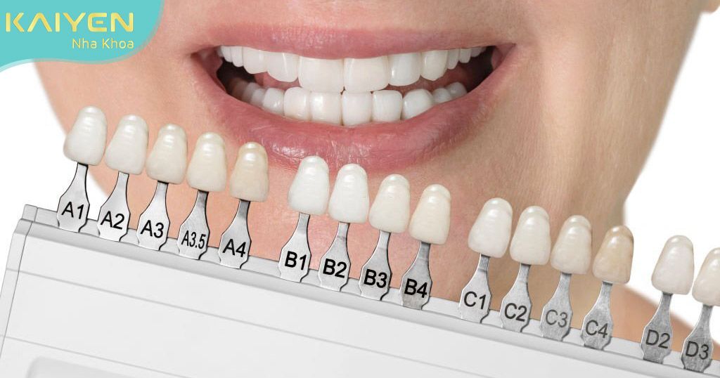 Giá dán răng sứ Emax có sự chênh lệch tùy vào kỹ thuật sản xuất