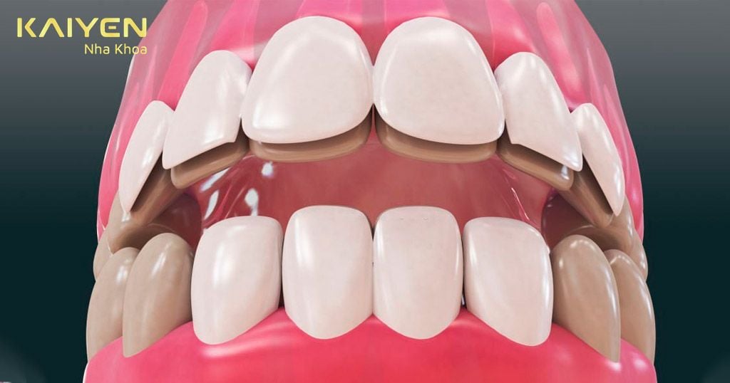 So sánh dán răng sứ và bọc răng sứ