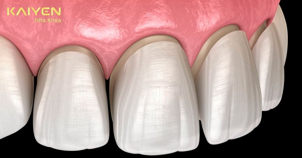 Dán răng sứ cải thiện thẩm mỹ cho răng