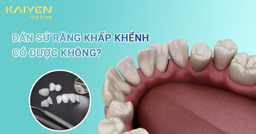 Dán sứ răng khấp khểnh có được không?