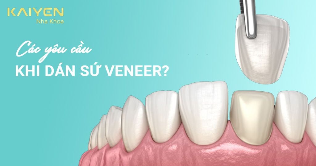 Muốn dán sứ Veneer thì răng phải đạt các tiêu chuẩn bắt buộc