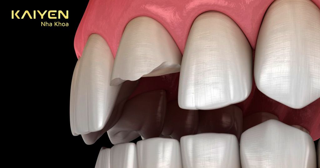 Răng xỉn màu nặng nên dùng phương pháp bọc sứ