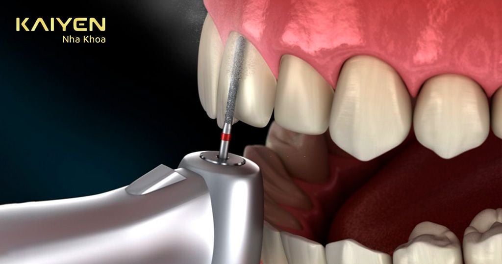 Mài 0.3 – 0.6mm men răng để dán sứ
