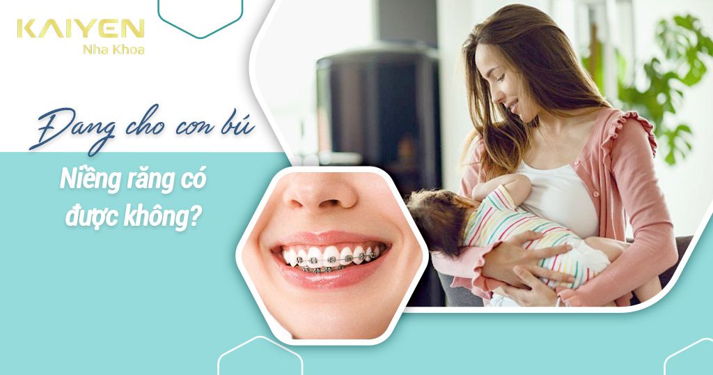 Đang cho con bú niềng răng được không? Sau sinh bao lâu tốt nhất? – Nha ...