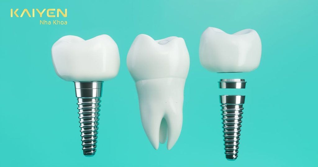 Kỹ thuật trồng răng Implant đòi hỏi nhiều yêu cầu về sức khỏe tổng quát