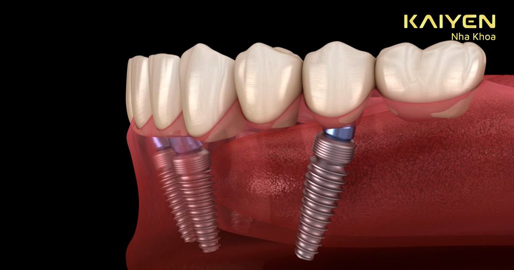Trụ Implant cấy ở xương hàm thường bị lệch so với khoảng mất răng