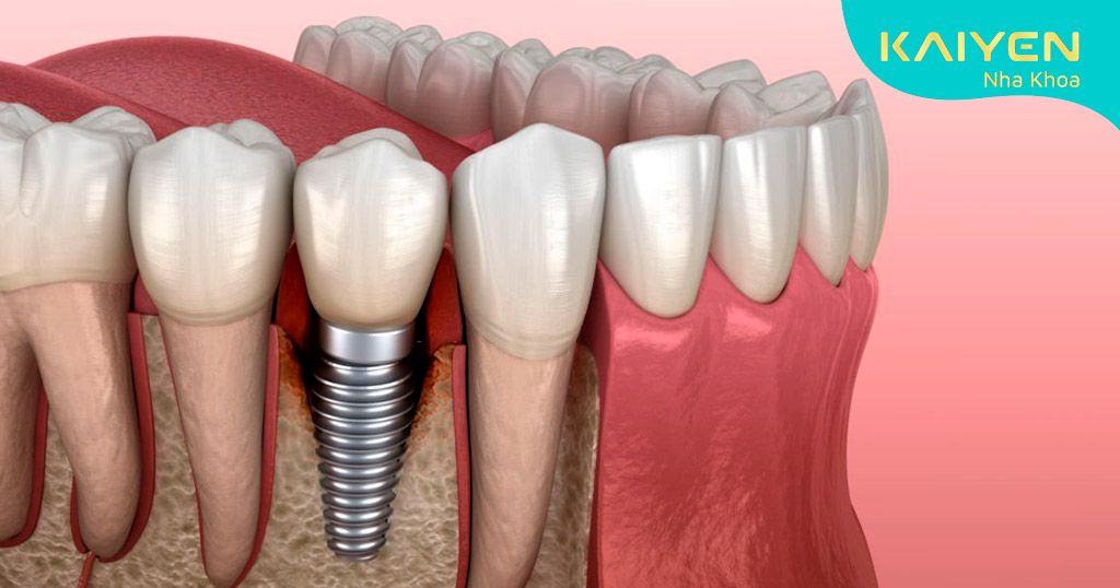 Vi khuẩn tấn công vào nướu gây viêm nhiễm, thậm chí có thể lan ra răng kế cận