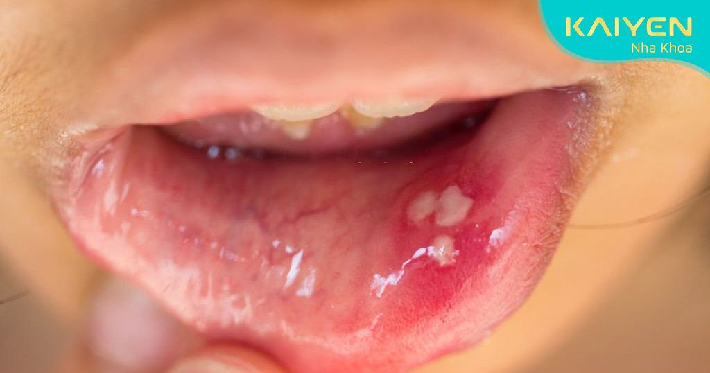 Loét miệng là dấu hiệu khi mới niềng răng thường gặp