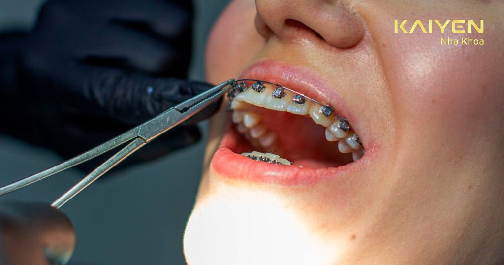 Thay dây cung niềng răng sau 1 – 2 tháng
