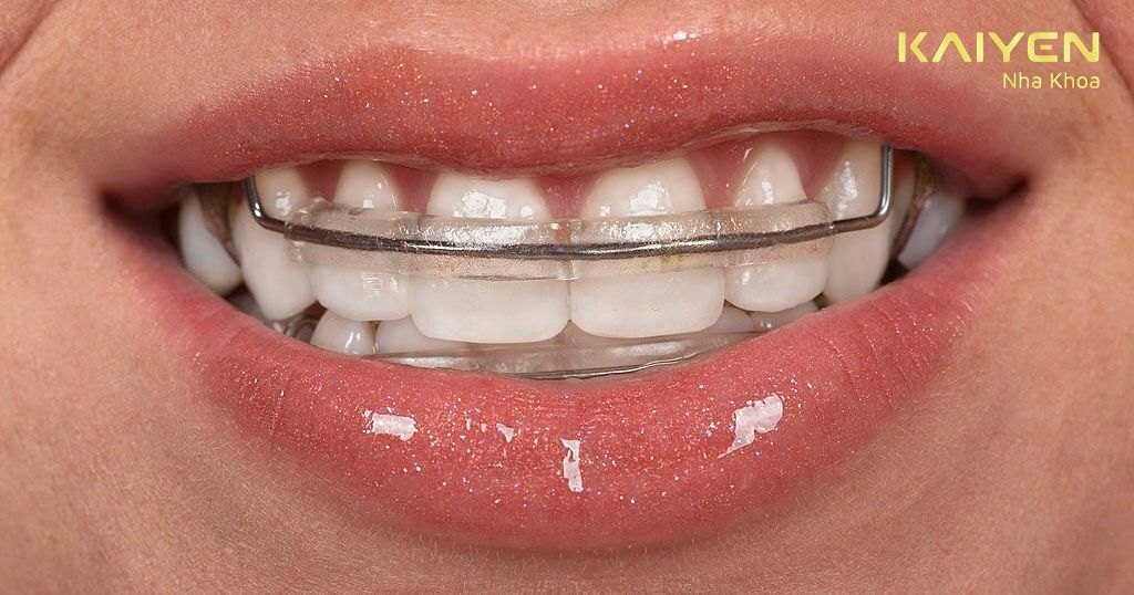 Đeo hàm duy trì để ổn định cung răng