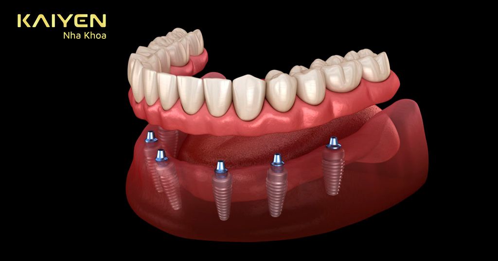 Răng giả trên trụ Implant