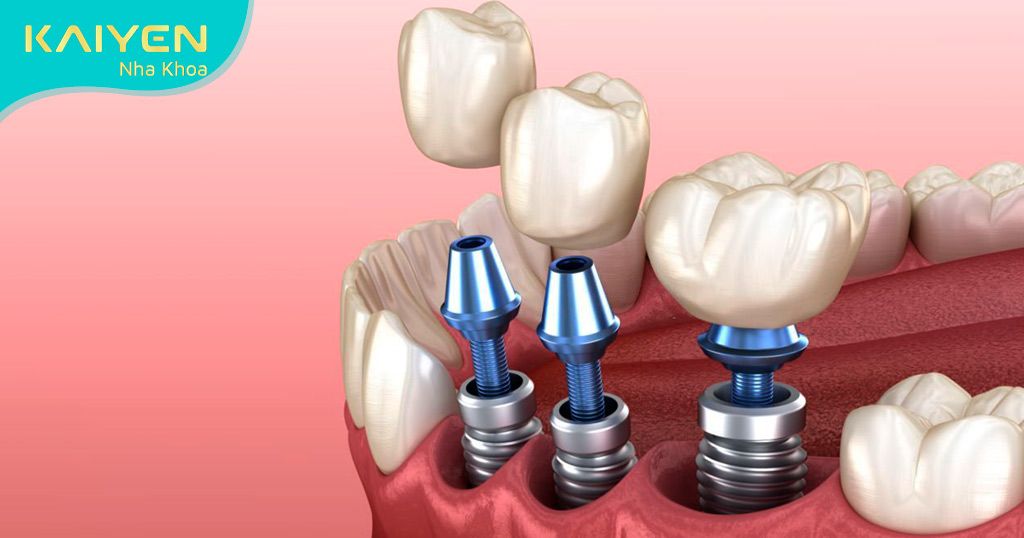 Răng Implant cảm nhận tốt vị ngon của thức ăn