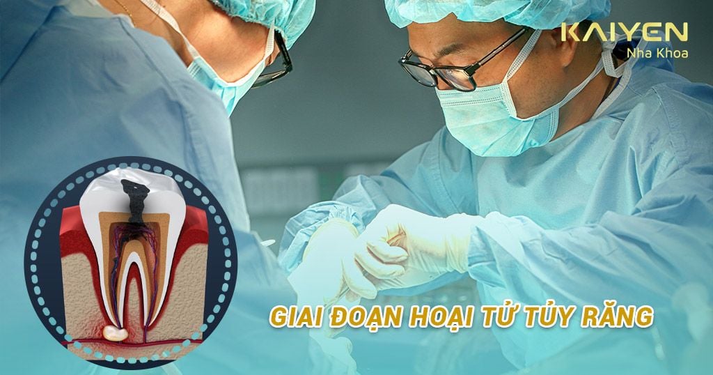 Bác sĩ điều trị diệt tủy ở giai đoạn hoại tử