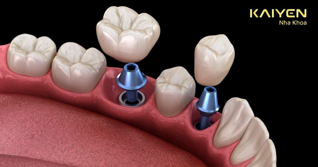 Cấy trụ Implant vào vị trí mất răng