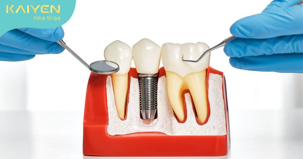 Lưu ý 5 điều kiện để trồng răng Implant an toàn, hiệu quả