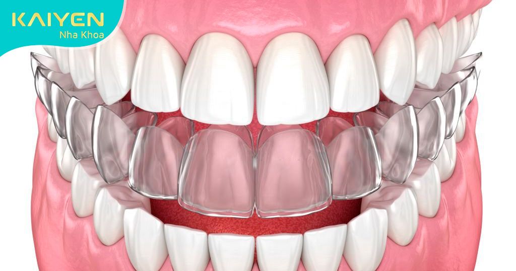 Niềng răng trong suốt rút ngắn thời gian điều trị