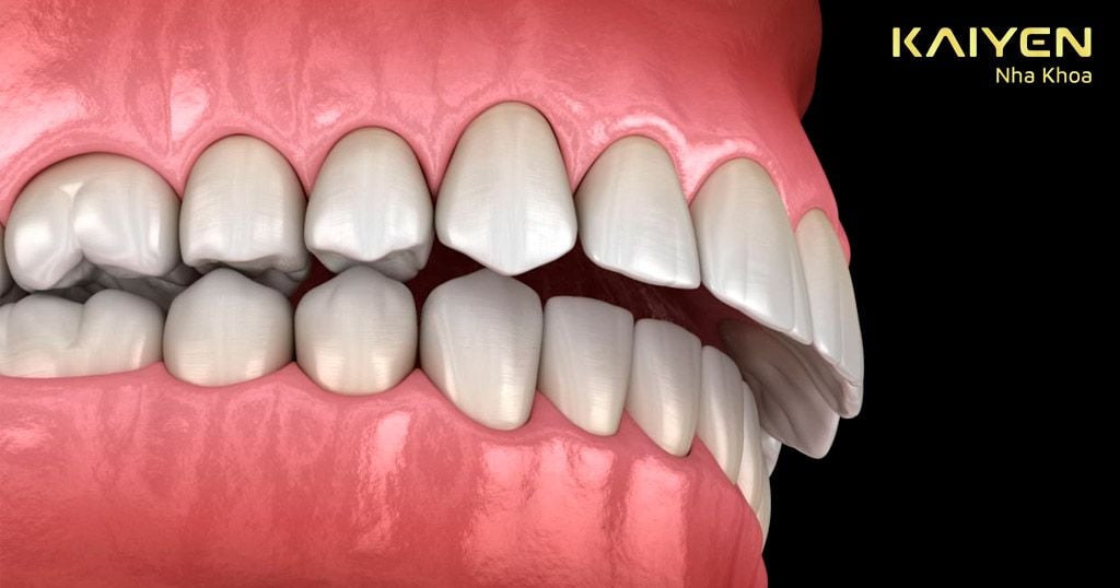 Răng bị hô nhẹ phải làm sao? Phương pháp xử lý hiệu quả nhất – Nha ...