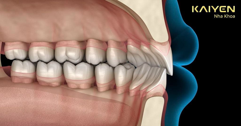 Răng hô nhẹ cần xác định bằng cách chụp X-quang răng
