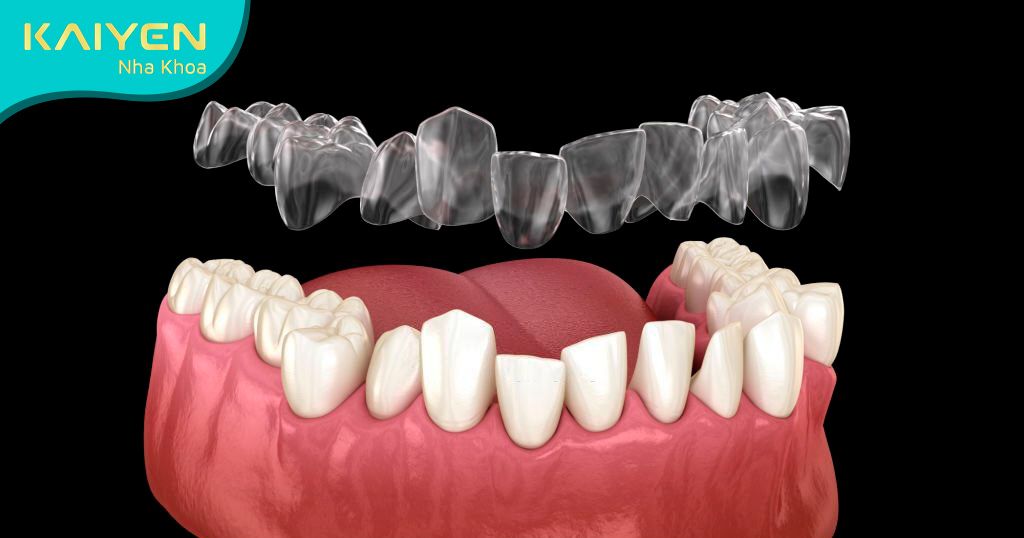 Niềng răng trong suốt Invisalign phù hợp với mọi tình trạng răng
