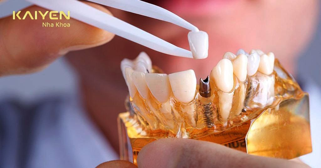 Gắn răng Implant hay còn gọi là lắp mão răng sứ lên trên trụ Implant