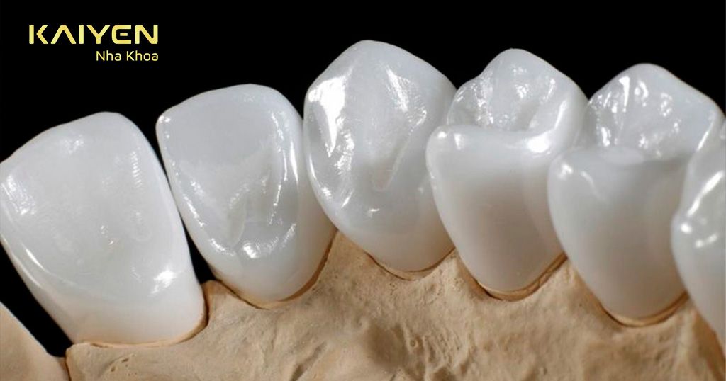 Răng sứ Zirconia có màu trắng, trong tự nhiên
