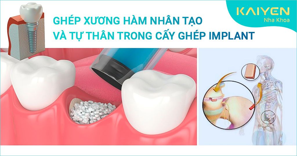 Ghép xương hàm nhân tạo và tự thân trong cấy ghép Implant