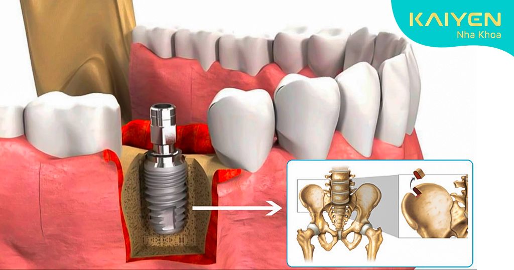 Ghép xương hàm tự thân khi trồng Implant