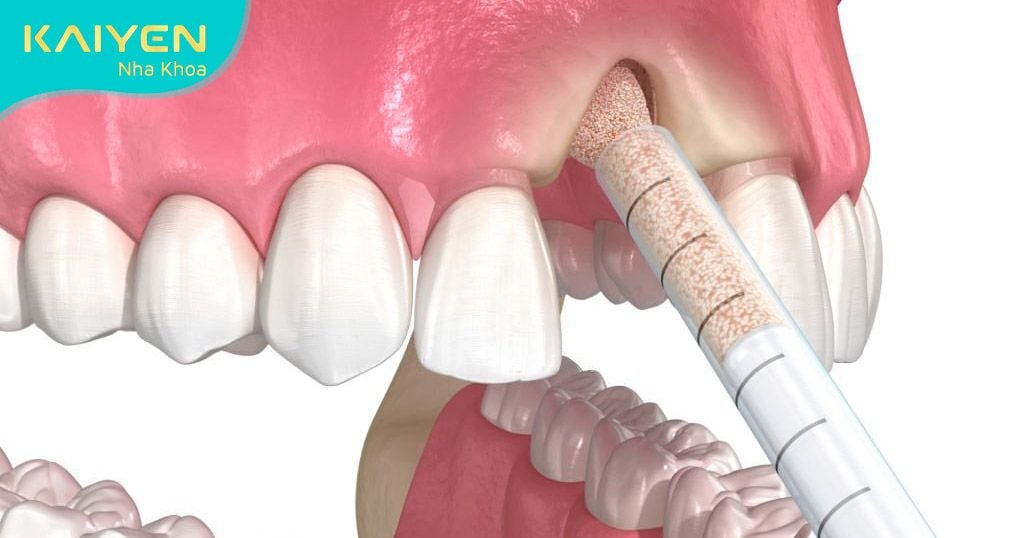Khi nào cần ghép xương răng? Có mấy loại? Có nguy hiểm không?