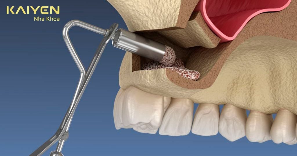 Ghép xương trong cấy Implant có đau không? Bao lâu thì lành?