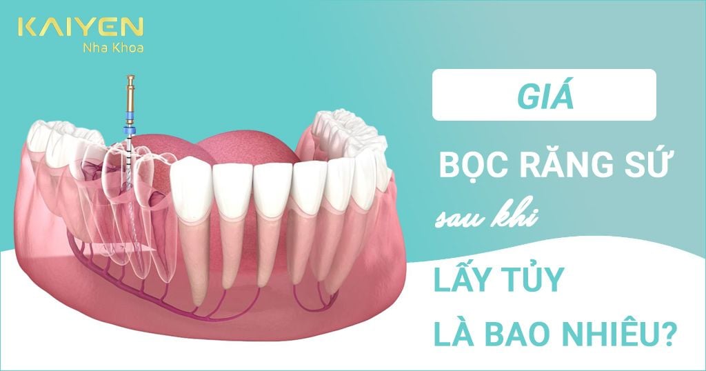 Giá bọc răng sứ sau khi lấy tủy là bao nhiêu?